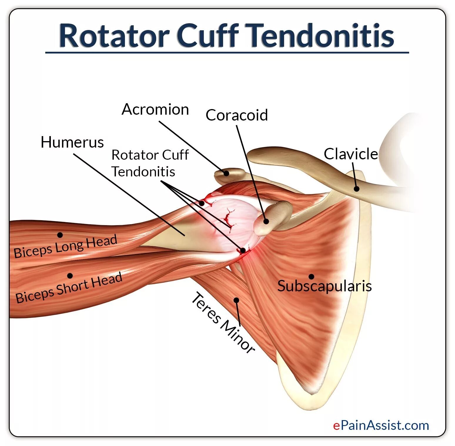Почему болит сустав плеча. Мышцы ротаторной манжеты плечевого сустава. Тендинит ротаторной манжеты плеча. Тендинит мышцы плечевого сустава.