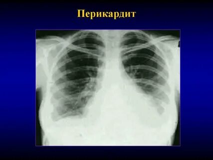 Перикардит это