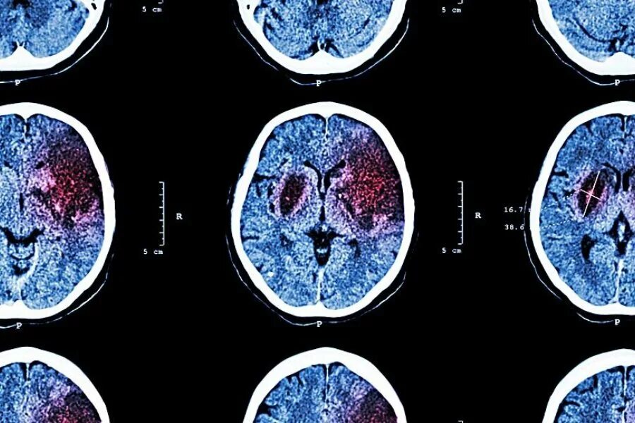 Ишемический инсульт кт. Мозг после ишемического инсульта. Кт головного мозга при инсульте. Снимок мозга после инсульта.