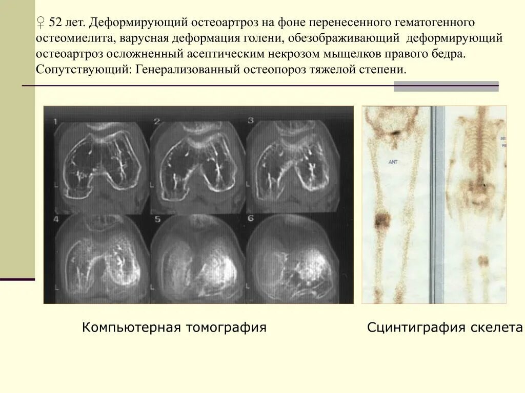 Диагноз доа суставов. Деформирующий остеоартроз кт. Первичный деформирующий остеоартроз. Деформирующий остеоартроз стадии. Деформирующий остеоартроз, деформирующий остеоартроз.