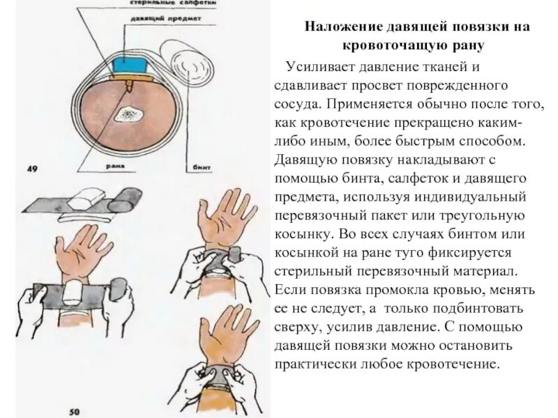Алгоритм наложения давящей повязки. Техника наложения давящей повязки при кровотечении. наложение давящей повязки для остановки кровотечения алгоритм. давящая повязка применяется для остановки кровотечения. этапы алгоритма наложения давящей повязки.
