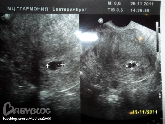 Плодное яйцо видно при хгч. Плодное яйцо 6 недель по узи. плодное яйцо 4-5 недель узи.