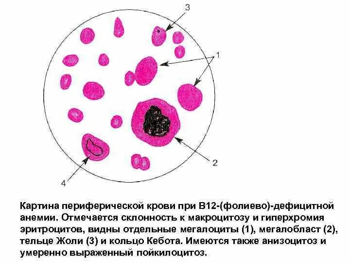 В12 в эритроцитах. Картина периферической крови при в12 дефицитной анемии. в12 дефицитная анемия кровь. тельца жолли кольца кебота анемия в12. в12 фолиеводефицитная анемия картина крови.