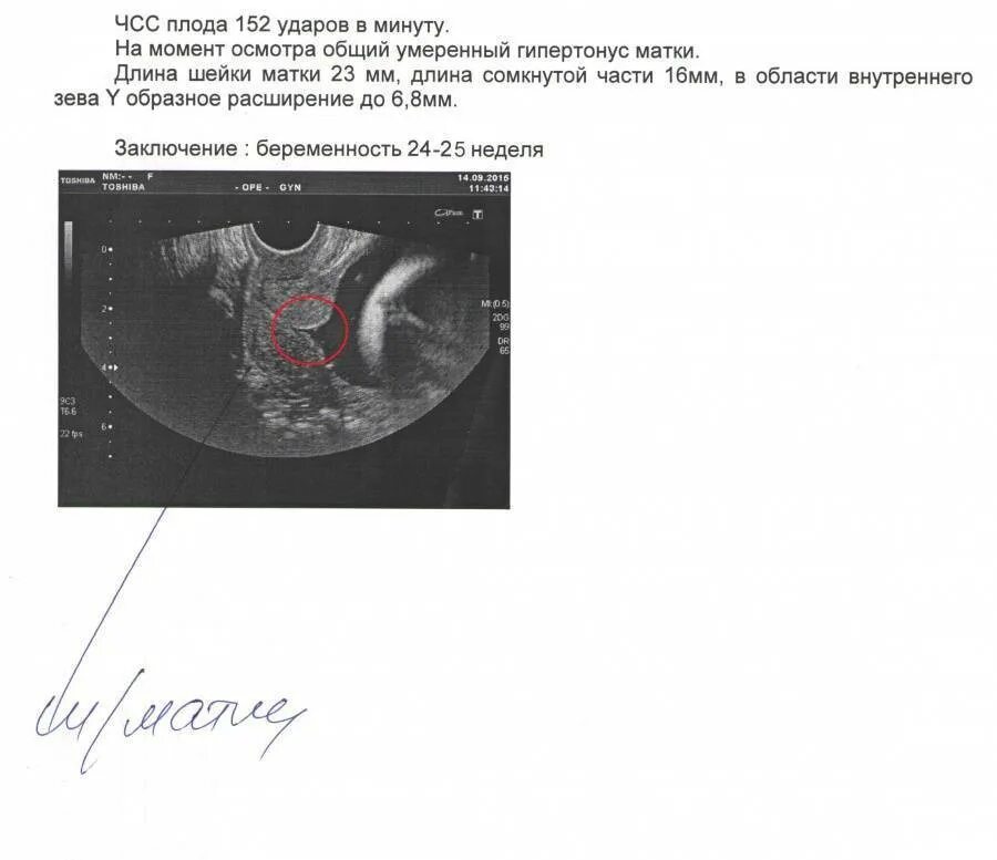Матка на 25 неделе. Цервикометрия протокол УЗИ. Расширение цервикального канала на УЗИ протокол. Цервикометрия заключение УЗИ. Цервикометрия при беременности протокол УЗИ.