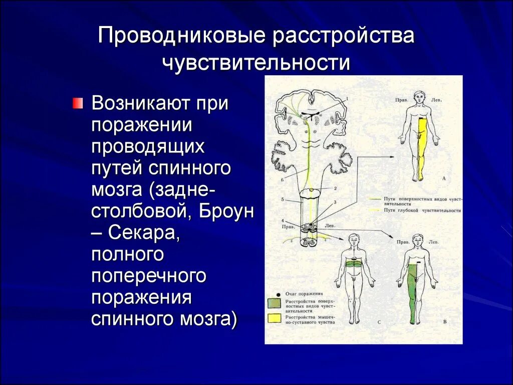 Типы поражения чувствительности. Проводниковые нарушения чувствительности неврология. Проводниковые расстройства чувствительности при поражении спинного. Проводниковый Тип нарушения чувствительности. Сегментарный проводниковый Тип расстройства чувствительности.