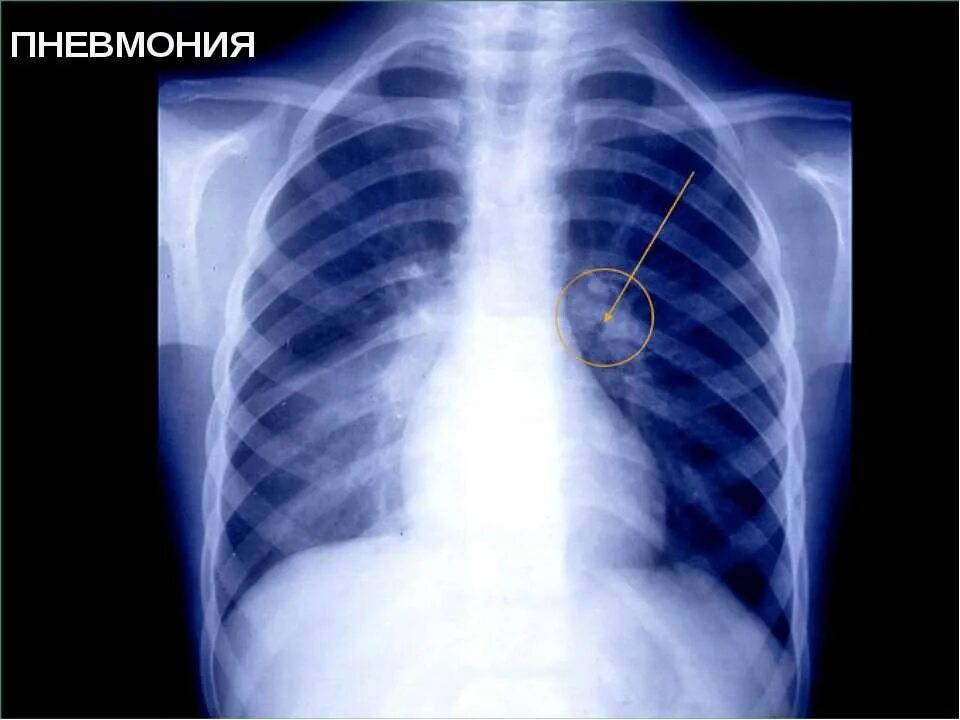 Болезни легких у детей. Атипичная пневмония рентген. Двусторонняя пневмония рентген. Рентген легких пневмония двухсторонняя.