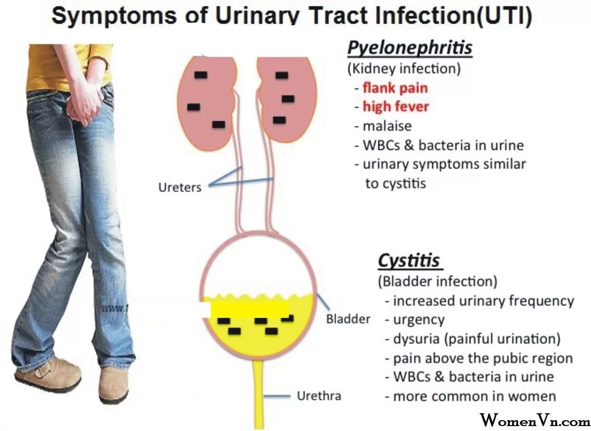 После мочеиспускания болит мочевой. Цистит у женщин симптомы. Симптомы цистицистита. Признаки цистита.