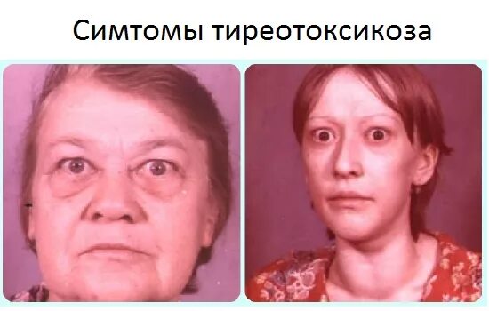Базедова болезнь гипертиреоз. Гипердориоз. Гипертиреоз кожа. Тиреотоксикоз гиперфункция щитовидной железы. Гиперфункция щитовидной железы (гипертиреоз).