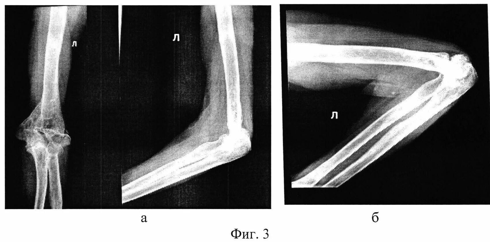 Контрактура локтевого сустава на рентгене. Ложный локтевой сустав. Ложный сустав локтевого сустава. Ложный сустав плечевой кости. Локтевого мыщелка