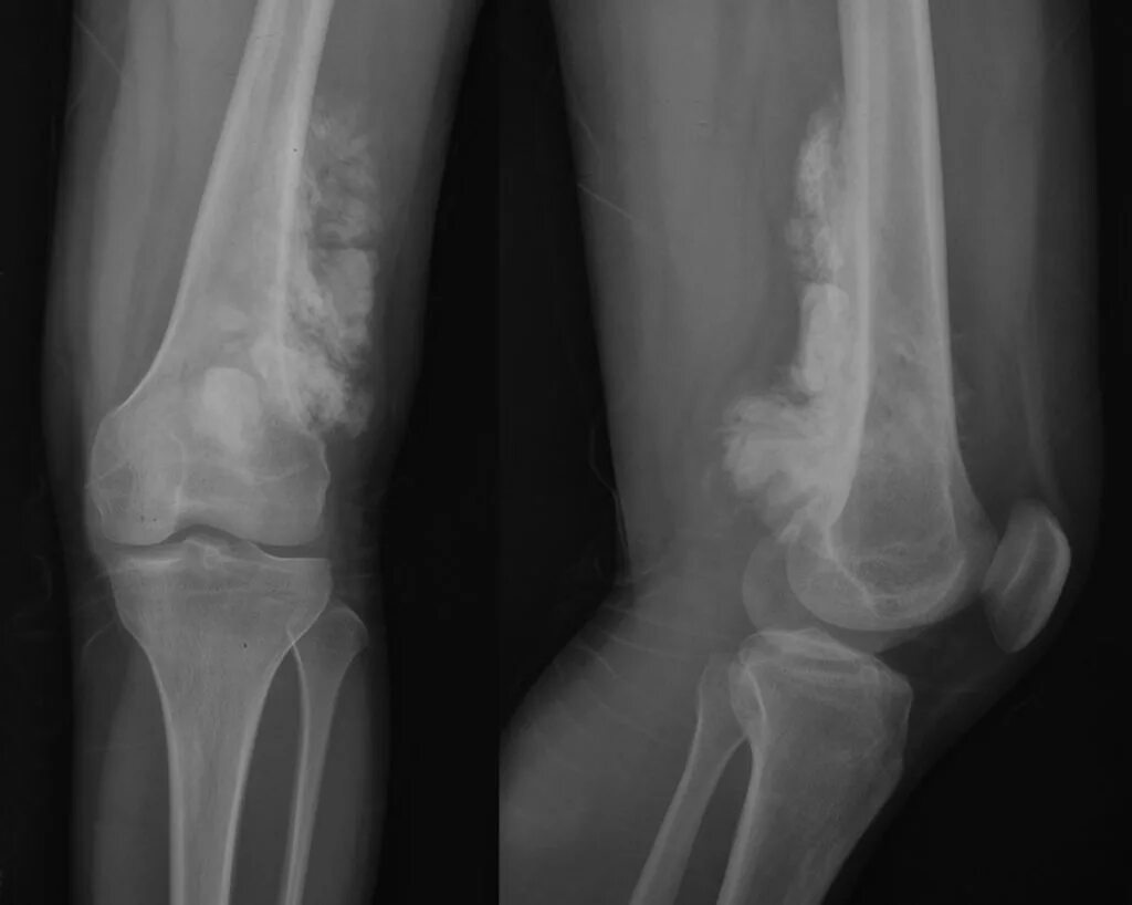 Остеосаркома препарат патанатомия. Sarcoma. Внекостная саркома юинга. Внекостная саркома юинга. Опухоль юинга рентгенологическая картина.