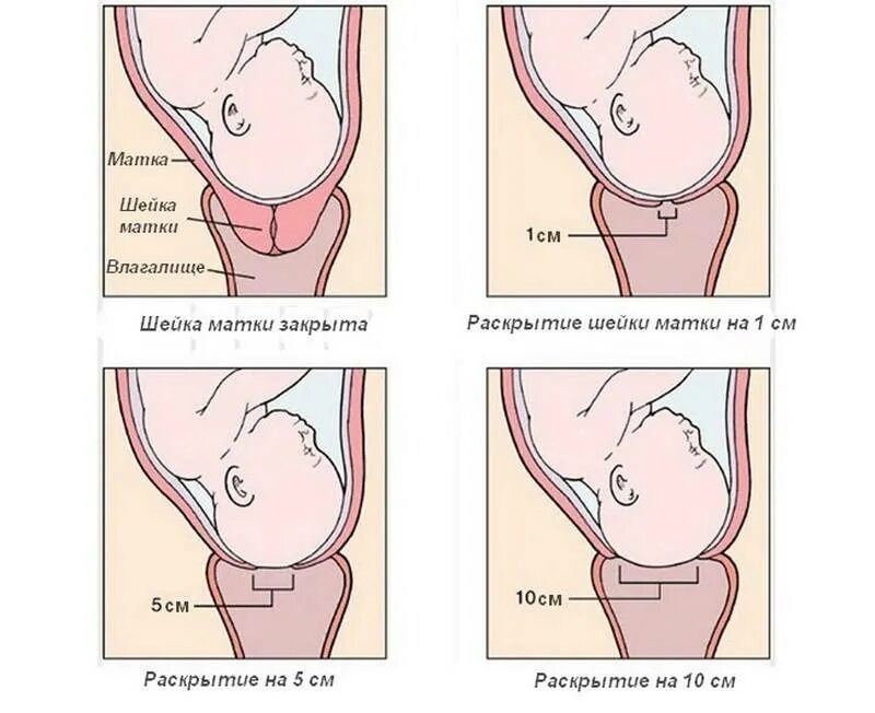 Раскрытие шейки матки при беременности. Раскрытая шейка матки перед родами. Раскрытие шейки матки при родах периоды. При короткой шейки матки при беременности. Беременность шейка 3