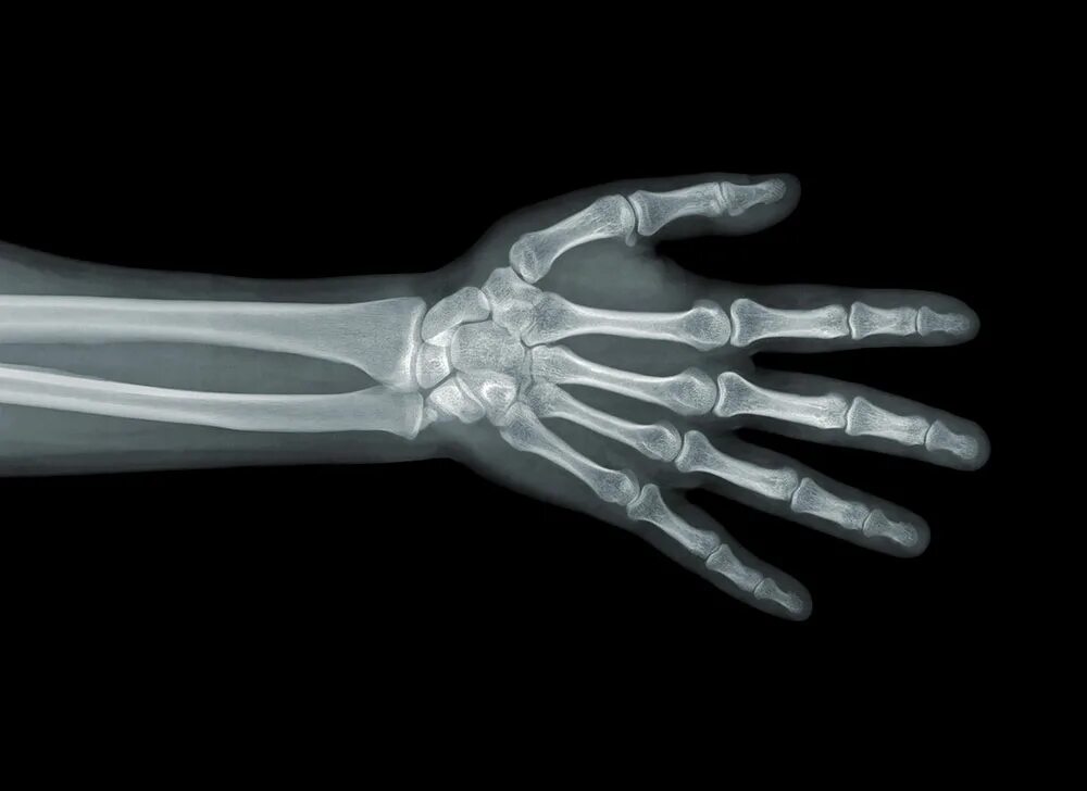 Рентген кисти норма. Рентген кисти правой руки норма. Лучезапястный сустав рентген здоровой руки. Рентгеновский снимок кисти.