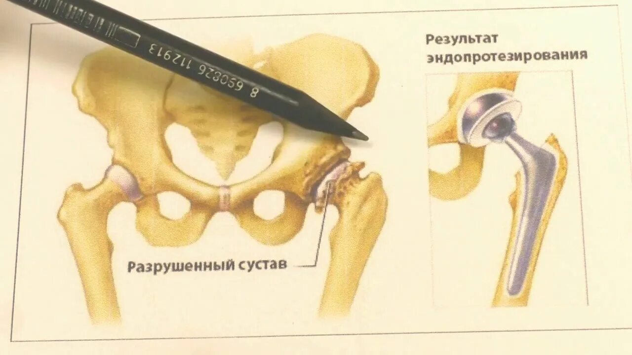 Боль в тазобедренном суставе причины. Как снять тазобедренный сустав. Боли после Интраджект в тазобедренный сустав. Болит шаровидный сустав что делать. Боли в тазобедренном суставе в состоянии покоя