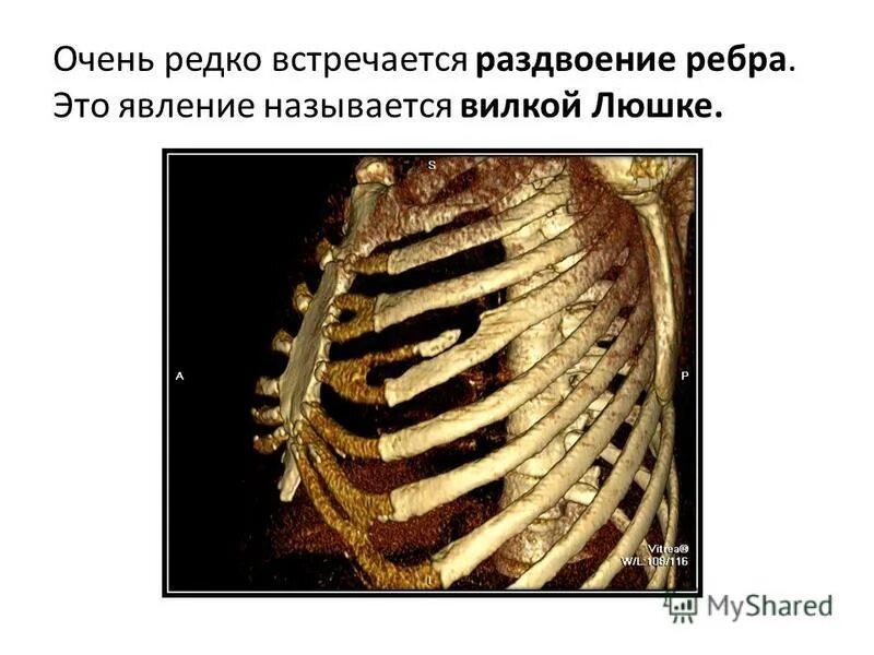 удвоенные ребра. ребра человека. удвоенные ребра. грудная клетка сзади анатомия. ребро люшко рентген.