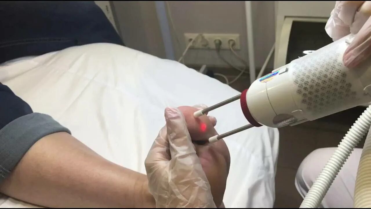 Прижигание бородавок лазером. Криодеструкция папиллом. Криодеструкция жидким азотом. Бородавка после прижигания азотом. Выжигание бородавок лазером.
