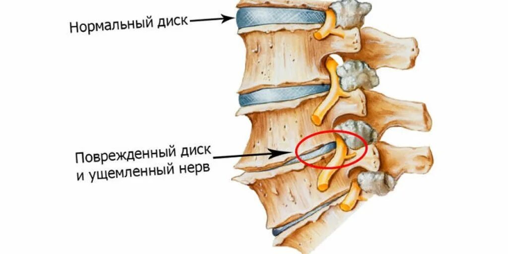 Хандроз или хондроз симптомы. Спондилез межпозвонковых суставов. Хондроз. Позвоночник и суставы. Острый хондроз.