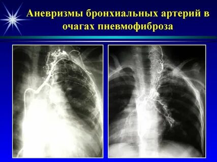 Профузное легочное кровотечение