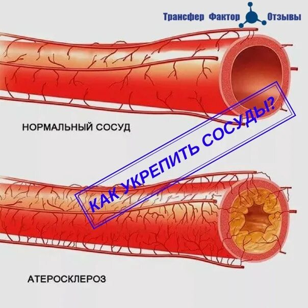 Сосуды оздоровление. Для укрепления сосудов. Кольца усиления для сосудов. Как укрепить сосуды в организме женщины. Препараты натуральные укрепление сосудов.