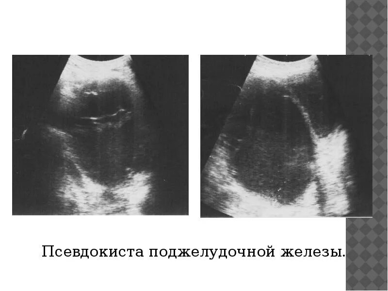 Псевдокиста поджелудочной железы кт. Псевдокисты поджелудочной железы на кт. Псевдокиста поджелудочной железы 22см. Абсцесс головки поджелудочной железы УЗИ.