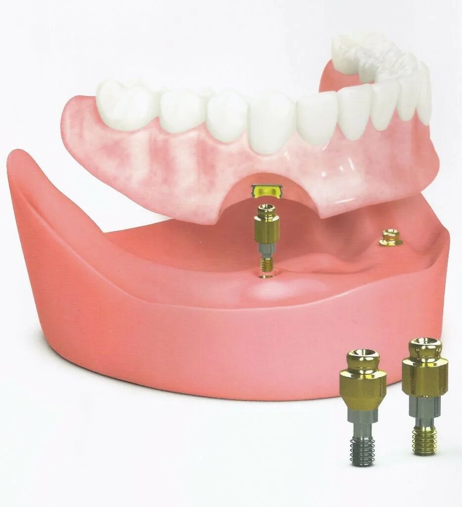 Съемный протез (3-5 зубов) термо Джет. Bio Implant протез. Локаторы на имплантатах Осстем. Съемный протез на имплантатах.