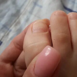 Впадина на ногте большого