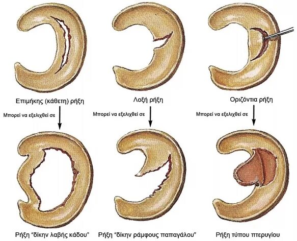 Типы разрывов мениска. Разрыв мениска по типу ручки лейки. Повреждения (разрыва) медиального мениска. Разрыв внутреннего мениска по типу ручки лейки. Классификация разрывов мениска по Stoller.