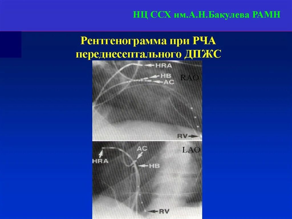 Операция рча отзывы пациентов. Трансвенозная катетерная радиочастотная абляция. РЧА методика проведения. Радиочастота катетерная облачия.