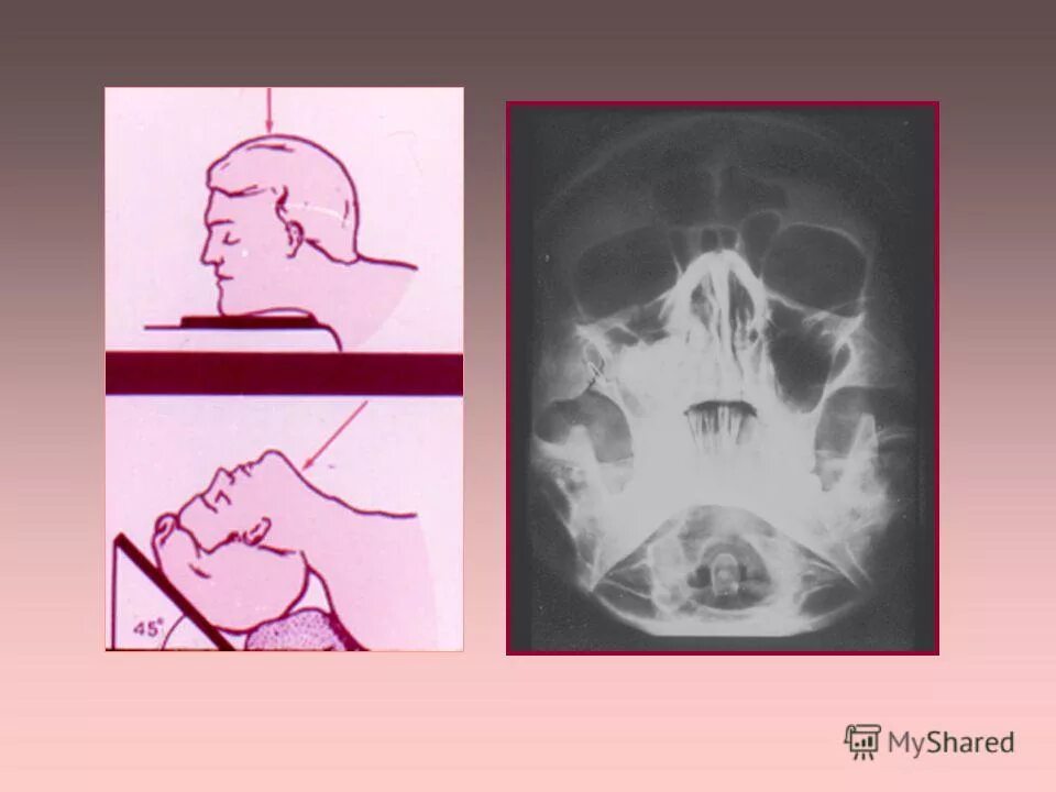 перелом скуловой кости рентген. перелом скуловой кости рентген черепа. скуловая кость рентген. рентгеноанатомия черепа пазухи. скуловая кость рентген.