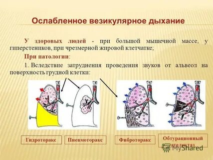 Везикулярных хрипов