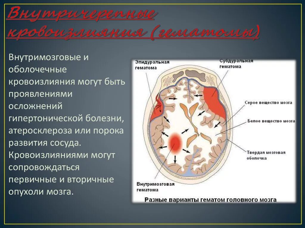 Субарахноидальное кровоизлияние патанатомия. Внутримозговое кровоизлияние патанатомия. Нейровизуализация субарахноидального кровоизлияния. Кровоизлияние в головном мозге причины и исходы.