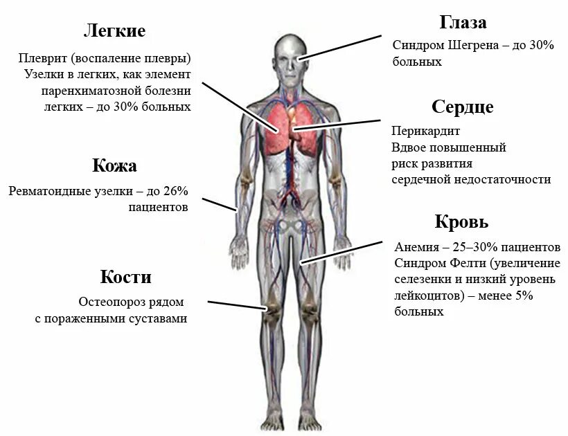 Ревматоидные узлы в легких. Ревматоидные узелки в легких. Ревматоидные узелки в легких при ревматоидном артрите. Легочные проявления ревматоидного артрита. Ревматоидный артрит легких