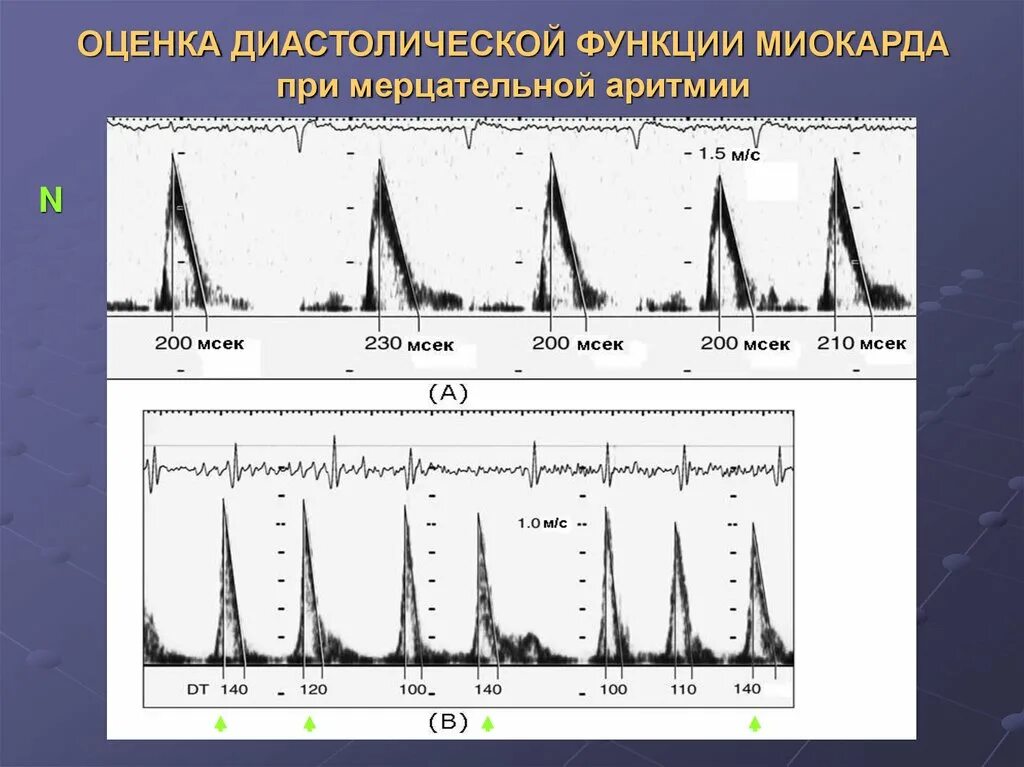 Диастолический понижен. Диастолическая дисфункция на ЭХОКГ. Оценка диастолической функции. Диастолическая функция лж норма. Диастолическая функция левого желудочка.