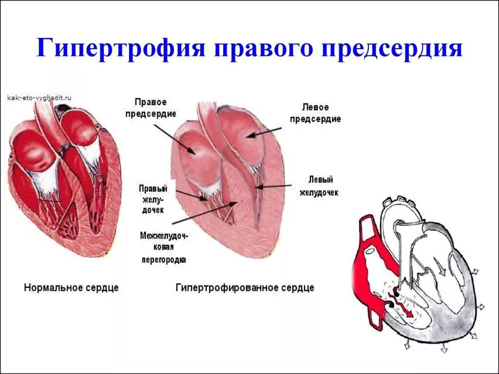 Гипертрофия правых отделов сердца. Гипертрофия левого предсердия и правого желудочка. Гипертрофия левого желудочка и предсердия. Гипертрофия миокарда левых отделов сердца что это. Увеличено правое предсердие