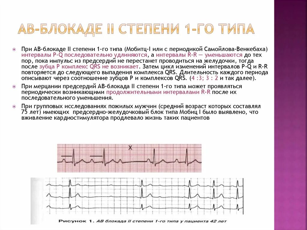 Блокада показания. АВ-блокада 2 степени Мобитц 1 Тип 2:1. АВ блокада 2 степени, 1 Тип (Мобиц 1). Аб блокада 2 степени Тип Мобитц 1. АВ блокада 2 степени типа 1 Мобитц 1 это.