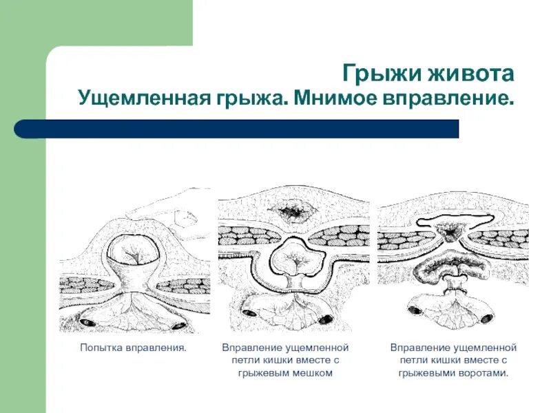 Вправление ущемленной грыжи. Мнимое вправление ущемленной грыжи живота. Мнимое вправление ущемленной грыжи. Грыж мнимое вправление грыжи. Ложное вправление ущемленной грыжи.