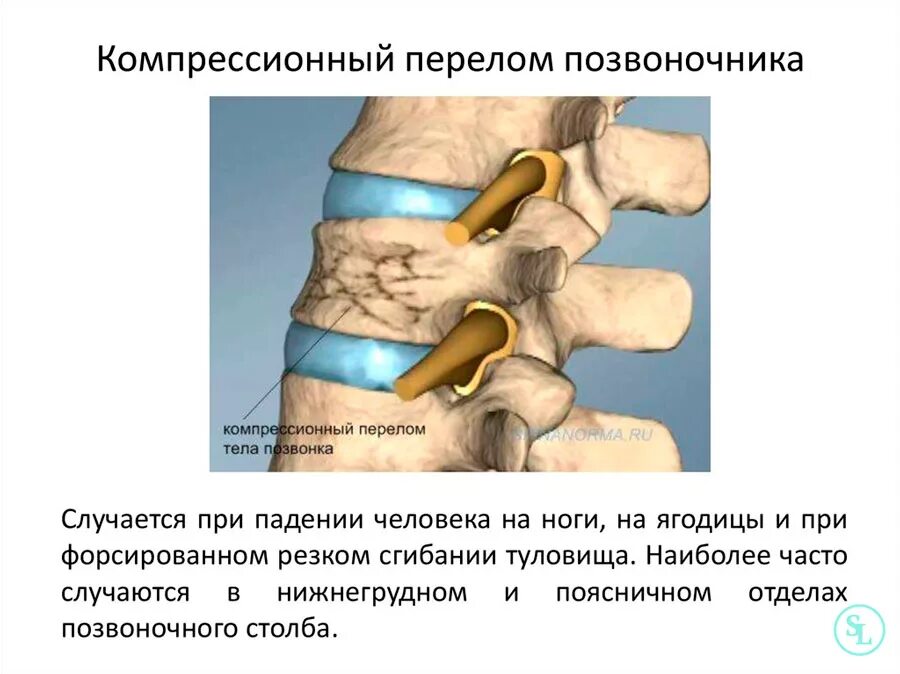 Компрессионный перелом позвоночника l1 операции. Компрессионный перелом 6 позвонка. Компрессионный перелом позвоночника th11-l1. Компрессионный перелом второго позвонка поясничного отдела. Компрессионный перелом тела 1 1