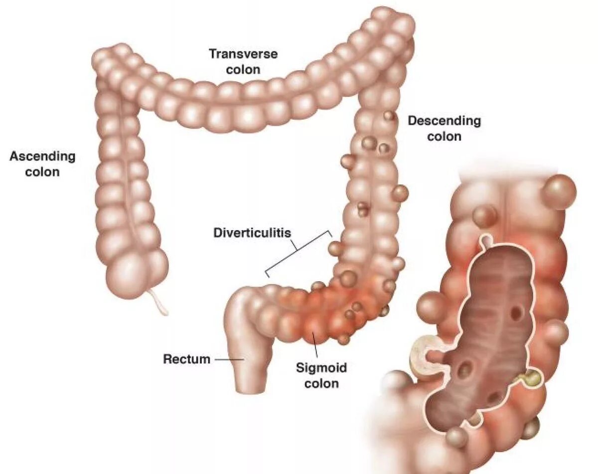 Дивертикулез сигмовидной кишки диета лечение. Дивертикул ободочной сигмовидной кишки. Дивертикулёз сигмовидной кишечник. Дивертикул кишечника сигмовидной кишки. Дивертикулёз кишечника клинические рекомендации.