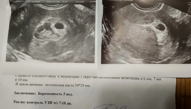 Снимок беременности 6 недель. Плодное яйцо на 2-3 недели беременности. Показывает ли узи 5 недель беременности. Узи 5-6 недель беременности. Показывает ли узи 5 недель беременности.