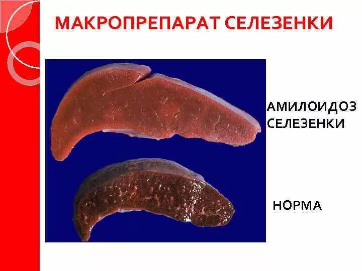 Селезенка здорового человека. Селезенка кроветворный орган. Цианотичная индурация селезенки. Селезенка это орган. Селезенка здорового человека.