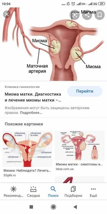 Лечение миомы матки без операции после. Без операций миома матки. характерная особенность миомы матки. частые симптомы миомы матки.