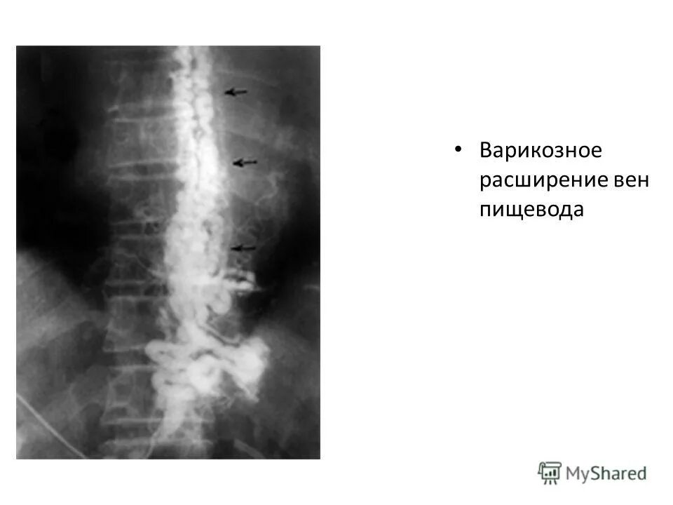 Портальная вена пищевода. Варикоз вен пищевода рентген. Расширение вен пищевода рентгенограмма. Варикозное расширение вен пищевода рентген. Варикозное расширение вен пищевода рентгенограмма.