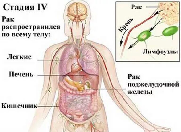 Метастазы 4 степени поджелудочной железы. 4 Стадии онкологии стадии.