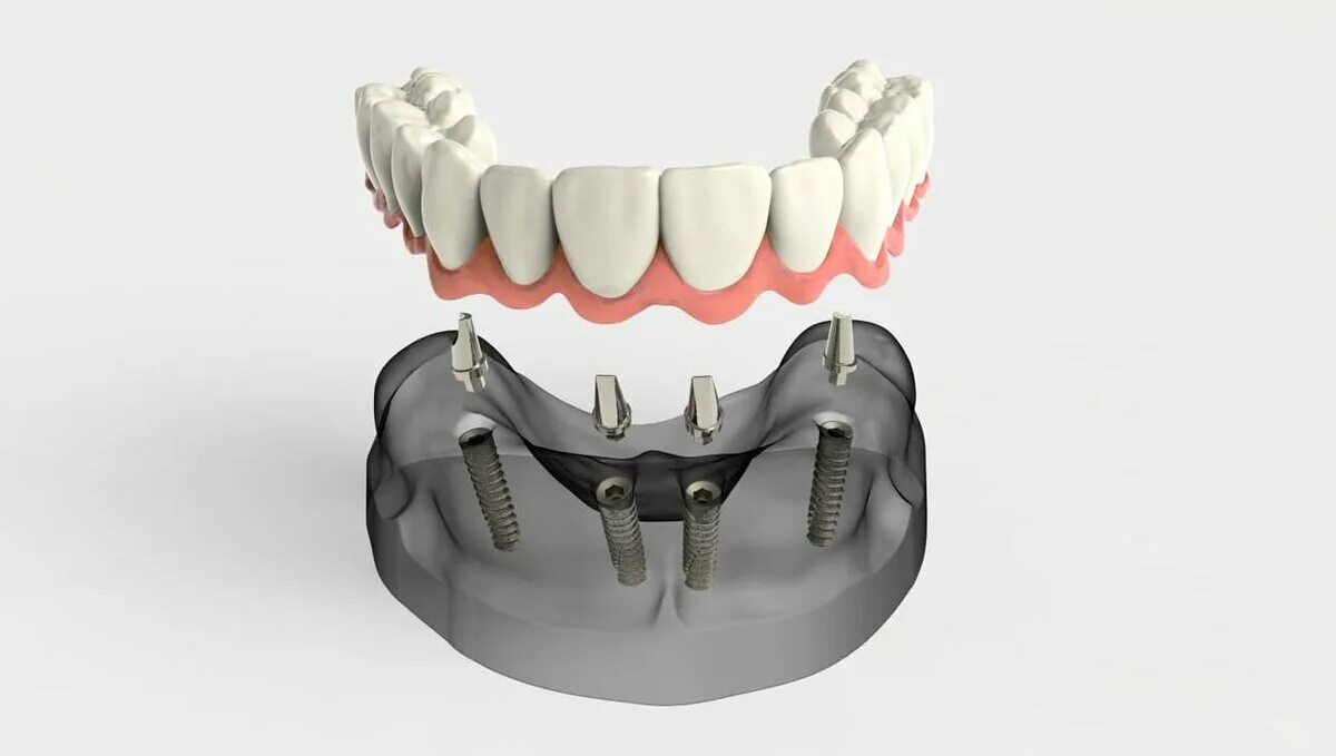 Протез нижней челюсти на 4 имплантах. Имплантация зубов all on 4. Имплантация всей челюсти all on 4.