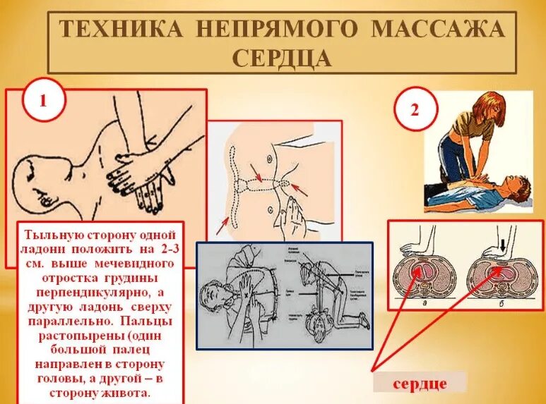 Прогиб грудины при массаже сердца. Порядок проведения наружного непрямого массажа сердца. техника выполнения наружного массажа сердца у взрослых. непрямой массаж сердца техника техника. непрямой массаж сердца техника выполнения 1.