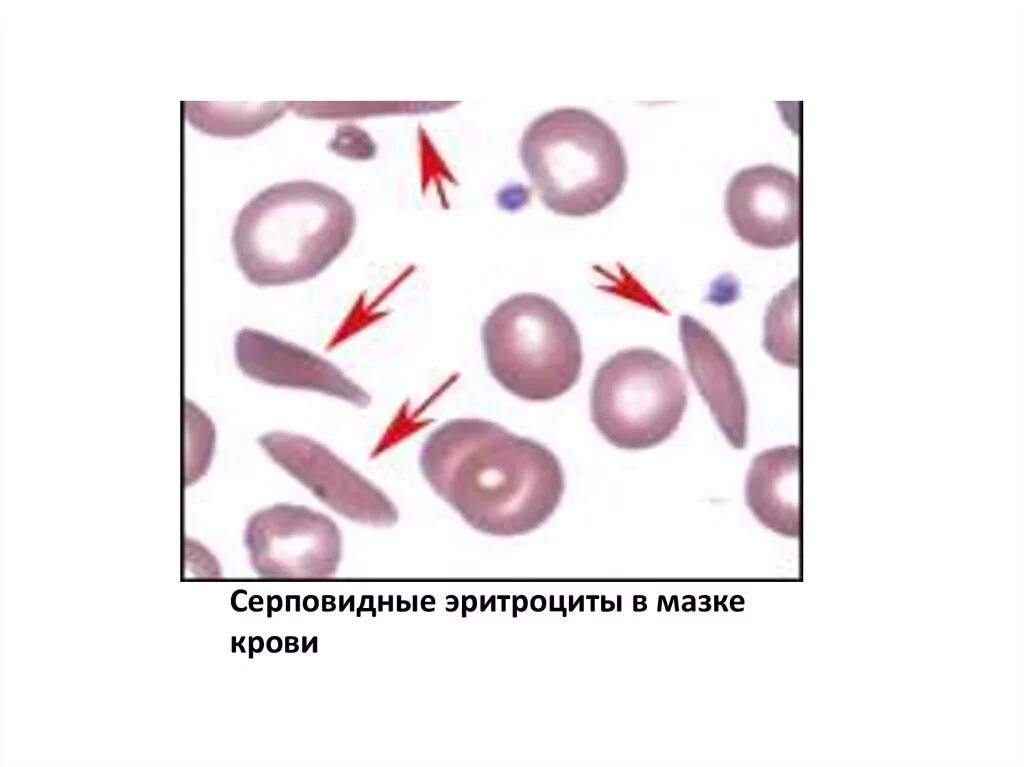 Эритроциты при серповидно клеточной анемии. Серповидноклеточная анемия мазок крови. Серповидно клеточная анемия мазок. Серповидноклеточная анемия гистология. Серповидноклеточная анемия под микроскопом.
