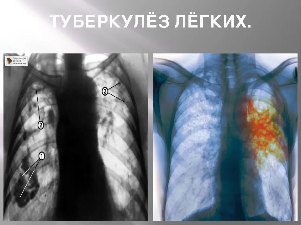 Туберкулез tuberculosis