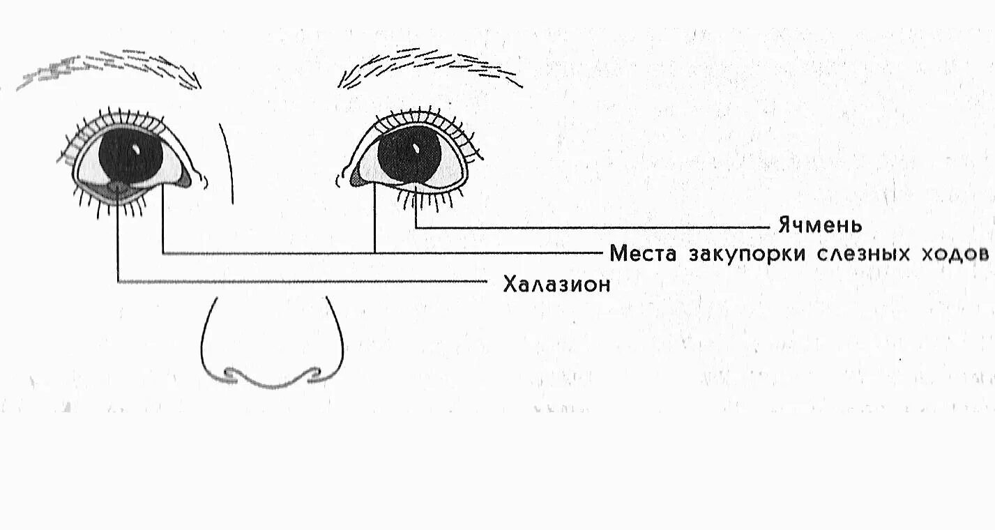 Как избавиться в домашних условиях от ячменя. Схема лечения внутреннего ячменя на глазу. Ячмень стадии развития глазной.