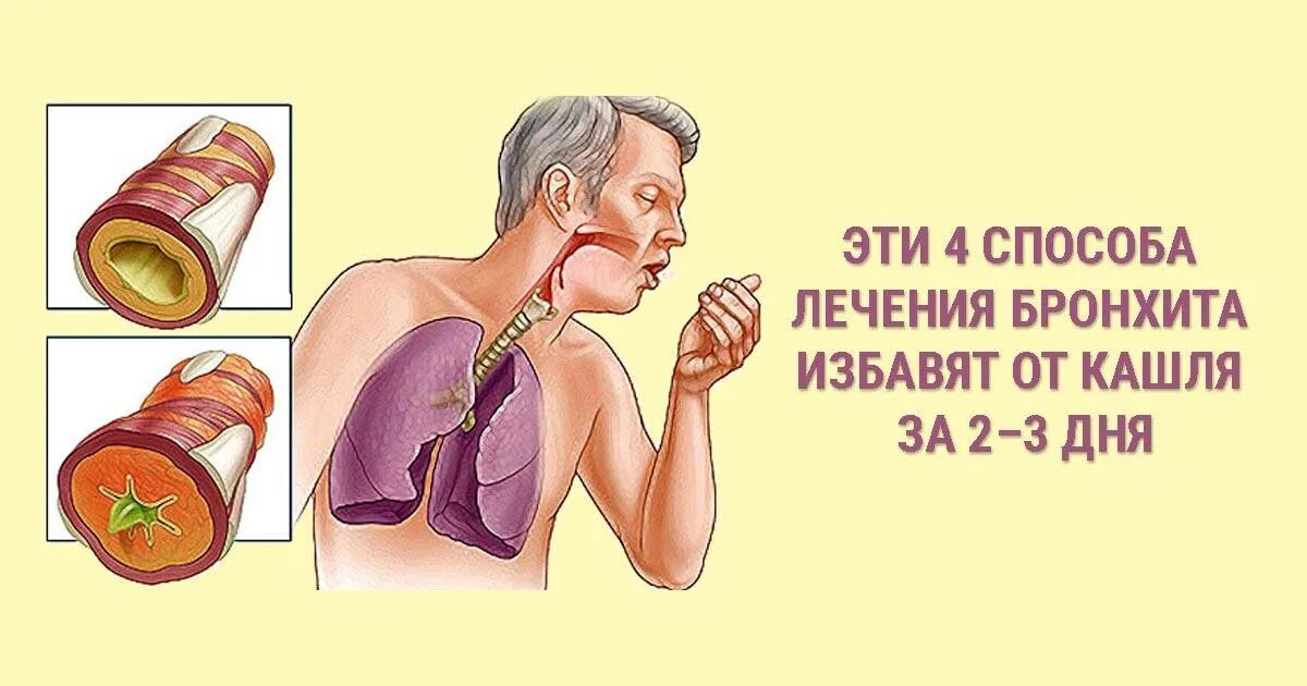 Можно ли прогревать бронхит. Можно ли прогревать бронхит