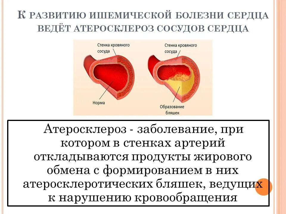 Симптоматика острого инфаркта. Признаки болевой формы инфаркта миокарда. Причины развития острого инфаркта миокарда.