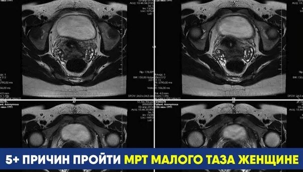 Питание перед мрт. Мрт малого таза Сергея Березина. Мрт малого таза у женщин. Компьютерная томограмма малого таза. Подготовка к мрт малого таза.